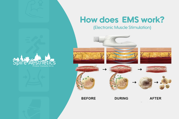 EMS treatment for post pregnancy weight loss treatment Walsall Wood