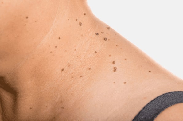 Are you looking for easy skin tag removal Walsall Wood - then contact Spire today!