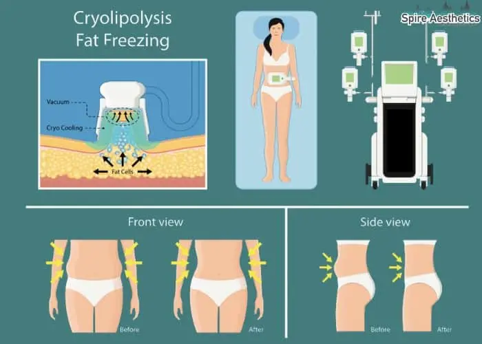 Fat freezing treatment Walsall Wood benefits for competitions to remove stubborn fat deposits.