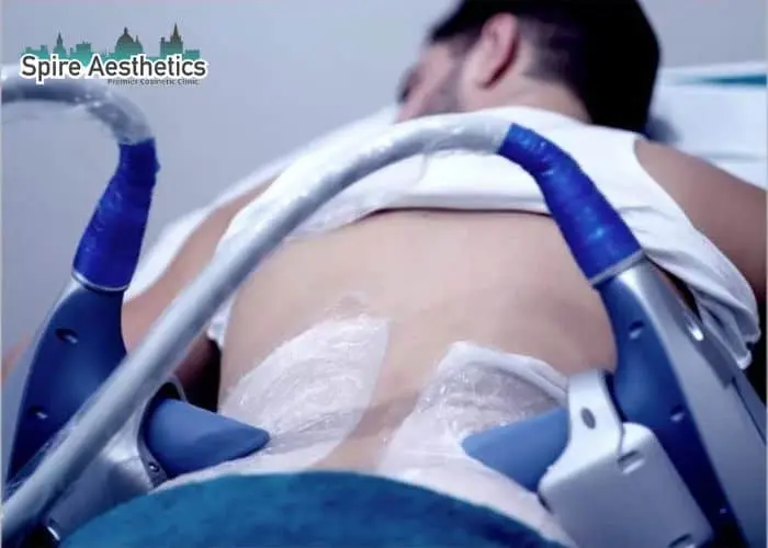 Man having fat freezing treatment done on love handles before a competitions Walsall Wood to create a sculpted look.