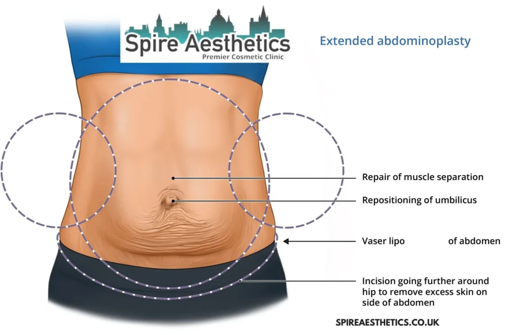 Understanding Loose Skin After Gastric Band Walsall Wood Surgery and HIFU Treatment