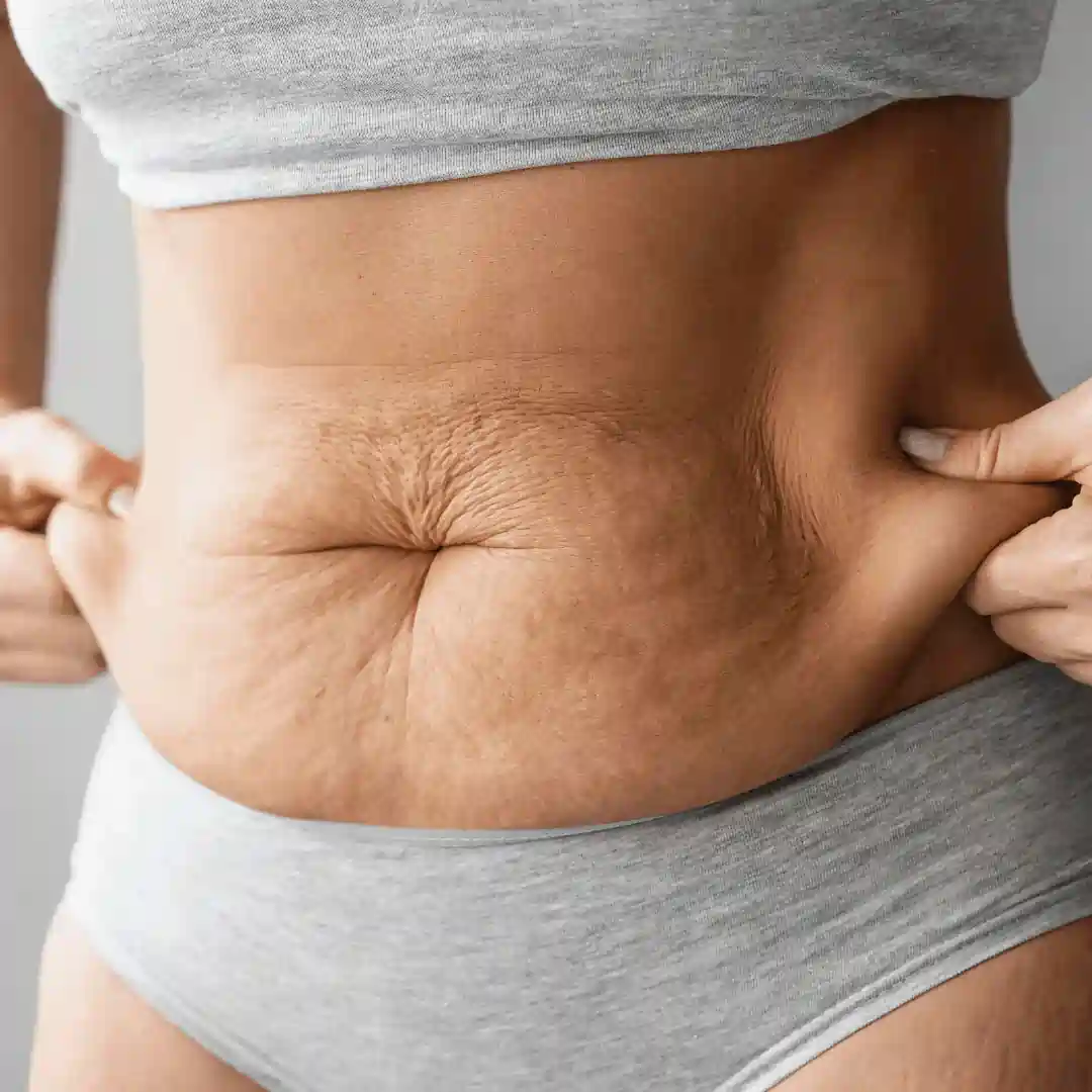 Is It Normal to Have Loose Skin After Pregnancy Walsall Wood?